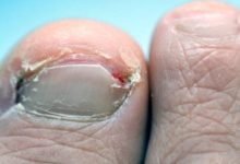 How To Removing Ingrown Toenails  At Home?