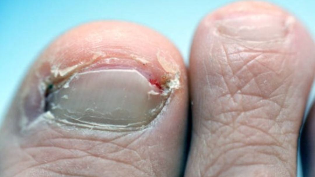 How To Removing Ingrown Toenails At Home