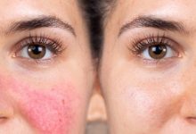 How Can Celibre's Age Spot Removal Treatments in Torrance Improve Your Skin's Appearance
